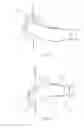 Fig. 09 - Endoluminal prosthesis comprising a valve replacement and at least one fenestration