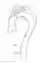 Fig. 03 - Thoracic stent graft with guide arrangement