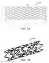 Fig. 12 - Implantable and lumen-supporting stents and related methods of manufacture and use
