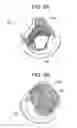 Fig. 06 - Stent-Valves for Valve Replacement and Associated Methods and Systems for Surgery