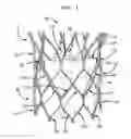 Fig. 02 - Leaflet suturing to commissure points for prosthetic heart valve