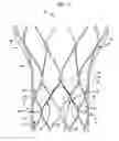 Fig. 03 - Leaflet suturing to commissure points for prosthetic heart valve