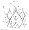 Fig. 04 - Leaflet suturing to commissure points for prosthetic heart valve