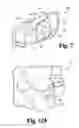 Fig. 07 - INTERBODY SPINAL IMPLANTS WITH MODULAR ADD-ON DEVICES