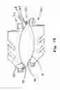 Fig. 14 - Anterior prosthetic spinal disc replacement