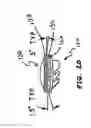 Fig. 17 - Anterior prosthetic spinal disc replacement