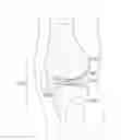 Fig. 01 - Joint Arthroplasty Devices