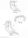 Fig. 24 - Joint Arthroplasty Devices