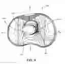 Fig. 10 - Constrained knee prosthesis