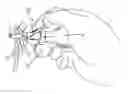 Fig. 01 - Knot loosening device