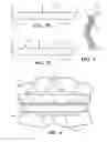 Fig. 03 - Orthodontic appliance shield