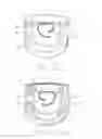 Fig. 06 - Deconstricting airway devices