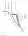 Fig. 04 - Saddle tap connection and installation device