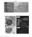 Fig. 02 - Methods and compositions to support transplanted tissue integration and innosculation with adipose stromal cells