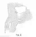 Fig. 03 - Minimally invasive implant and method