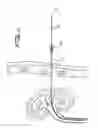 Fig. 28 - Percutaneous renal access system