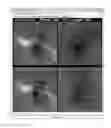 Fig. 03 - Global and semi-global registration for image-based bronchoscopy guidance