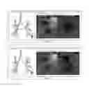 Fig. 06 - Global and semi-global registration for image-based bronchoscopy guidance