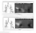 Fig. 08 - Global and semi-global registration for image-based bronchoscopy guidance