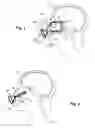 Fig. 02 - SURGICAL SHIELD FOR SOFT TISSUE PROTECTION