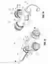 Fig. 13 - Endoluminal access device