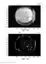 Fig. 04 - MAGNETIC RESONANCE IMAGING SYSTEM AND METHOD FOR DETECTING A GAS BUBBLE