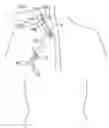 Fig. 01 - Methods and apparatus for inserting multi-lumen split-tip catheters into a blood vessel