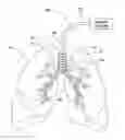 Fig. 01 - Systems, assemblies, and methods for treating a bronchial tree