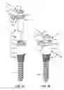 Fig. 02 - LOW PROFILE SPINAL PROSTHESIS INCORPORATING A CANNULATED BONE ANCHOR HAVING A DEFLECTABLE POST AND A COMPOUND SPINAL ROD