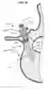 Fig. 10 - LOW PROFILE SPINAL PROSTHESIS INCORPORATING A CANNULATED BONE ANCHOR HAVING A DEFLECTABLE POST AND A COMPOUND SPINAL ROD