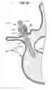 Fig. 13 - LOW PROFILE SPINAL PROSTHESIS INCORPORATING A CANNULATED BONE ANCHOR HAVING A DEFLECTABLE POST AND A COMPOUND SPINAL ROD