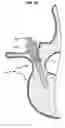 Fig. 14 - LOW PROFILE SPINAL PROSTHESIS INCORPORATING A CANNULATED BONE ANCHOR HAVING A DEFLECTABLE POST AND A COMPOUND SPINAL ROD