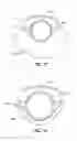 Fig. 11 - Method and Apparatus for Ablation of Benign, Pre-Cancerous and Early Cancerous Lesions That Originate Within the Epithelium and are Limited to the Mucosal Layer of the Gastrointestinal Tract