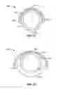 Fig. 13 - Method and Apparatus for Ablation of Benign, Pre-Cancerous and Early Cancerous Lesions That Originate Within the Epithelium and are Limited to the Mucosal Layer of the Gastrointestinal Tract