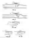 Fig. 27 - Method and Apparatus for Ablation of Benign, Pre-Cancerous and Early Cancerous Lesions That Originate Within the Epithelium and are Limited to the Mucosal Layer of the Gastrointestinal Tract