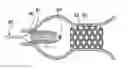 Fig. 01 - METHOD AND SYSTEM FOR DELIVERY OF COATED IMPLANTS