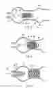 Fig. 04 - METHOD AND SYSTEM FOR DELIVERY OF COATED IMPLANTS
