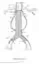 Fig. 02 - BIFURCATED STENT AND METHOD OF USE