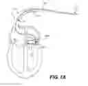 Fig. 02 - Method of post-operative adjustment for mitral valve implant