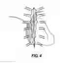 Fig. 06 - Method of post-operative adjustment for mitral valve implant