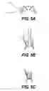 Fig. 07 - Method of post-operative adjustment for mitral valve implant