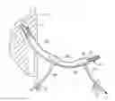 Fig. 01 - Percutaneous aortic valve