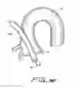 Fig. 18 - Percutaneous aortic valve