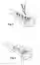 Fig. 03 - Prosthetic material for replacing at least one portion of the radial glenoid of a radius