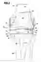 Fig. 02 - KNEE JOINT ENDOPROSTHESIS