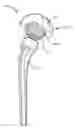 Fig. 01 - EXTENDED LIFE PROSTHETIC HIP JOINT
