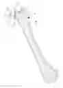 Fig. 01 - Minimally invasive total hip replacement