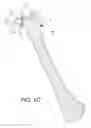 Fig. 03 - Minimally invasive total hip replacement