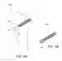Fig. 11 - Minimally invasive total hip replacement