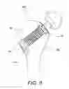 Fig. 14 - Minimally invasive total hip replacement